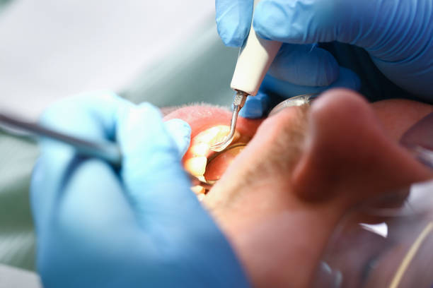 Best Emergency Root Canal Treatment in Glennville, GA