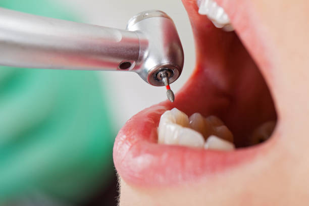 Best Emergency Root Canal Treatment in Glennville, GA
